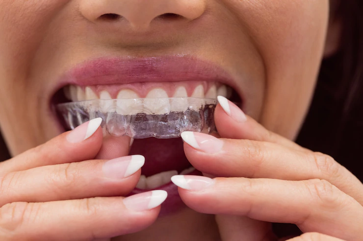 Ortodoncia Invisible: nuevo tratamiento en Dental Class
