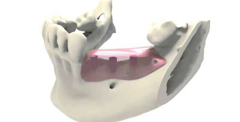 Barreras de titanio que regeneran el hueso necesario para colocar implantes dentales