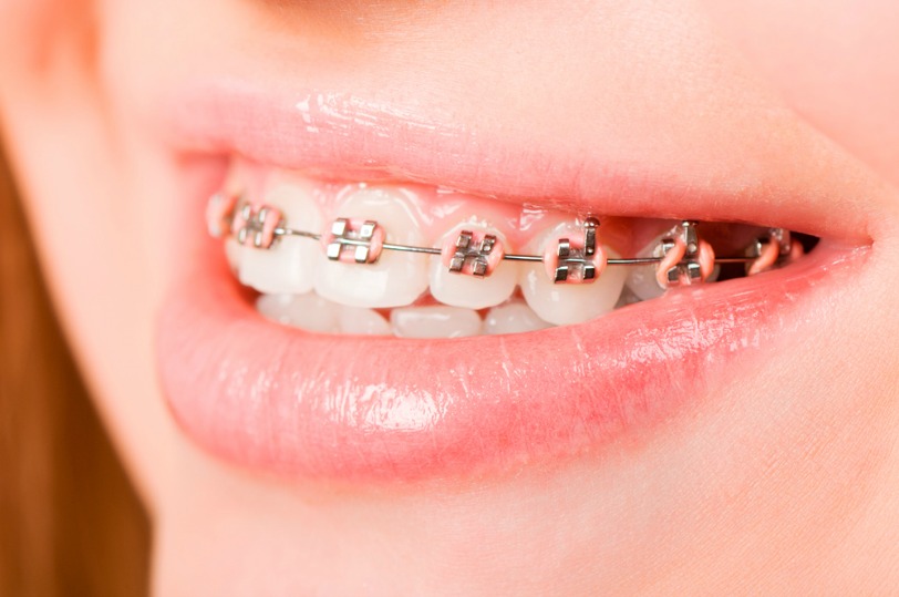 Ortodoncia Infantil, precios y tipos – Odontopediatría Dental Class León
