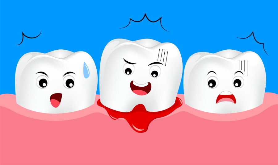 gingivitis