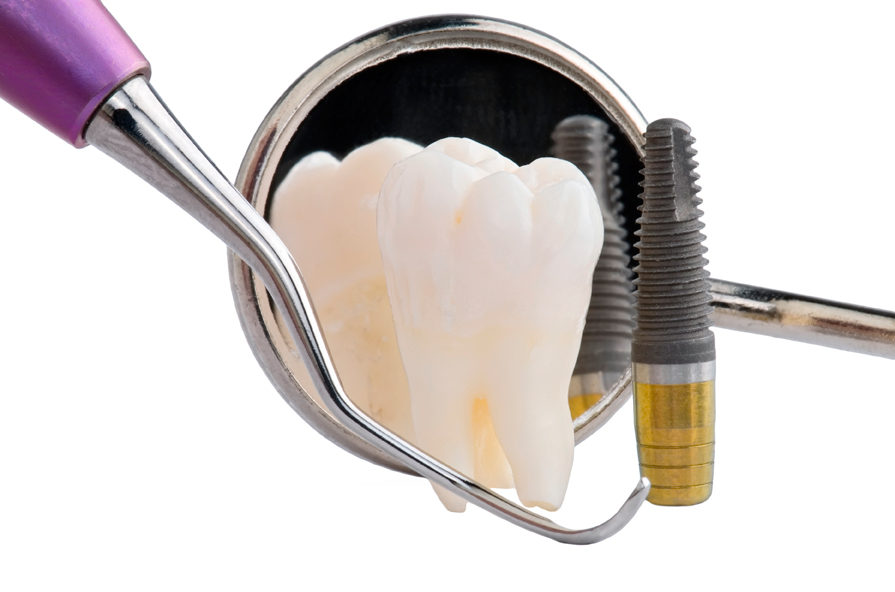 Implantes dentales en León. Lo que necesitas saber.