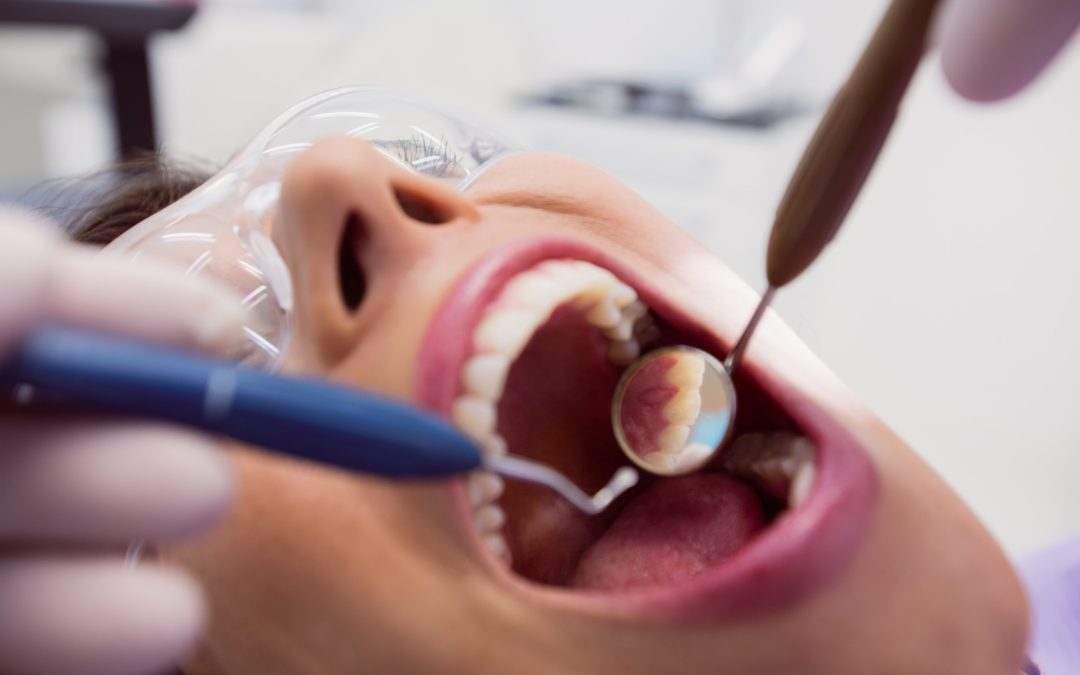 Cuidados después de un empaste dental: lo que necesitas saber