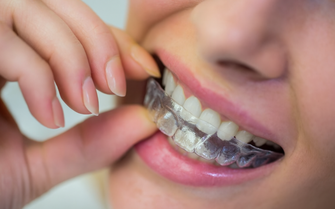 El paso a paso de tu ortodoncia invisible con Dental Class